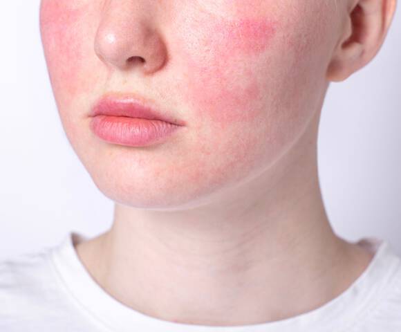 Eczéma visage : causes, symptômes et traitements | La Roche-Posay