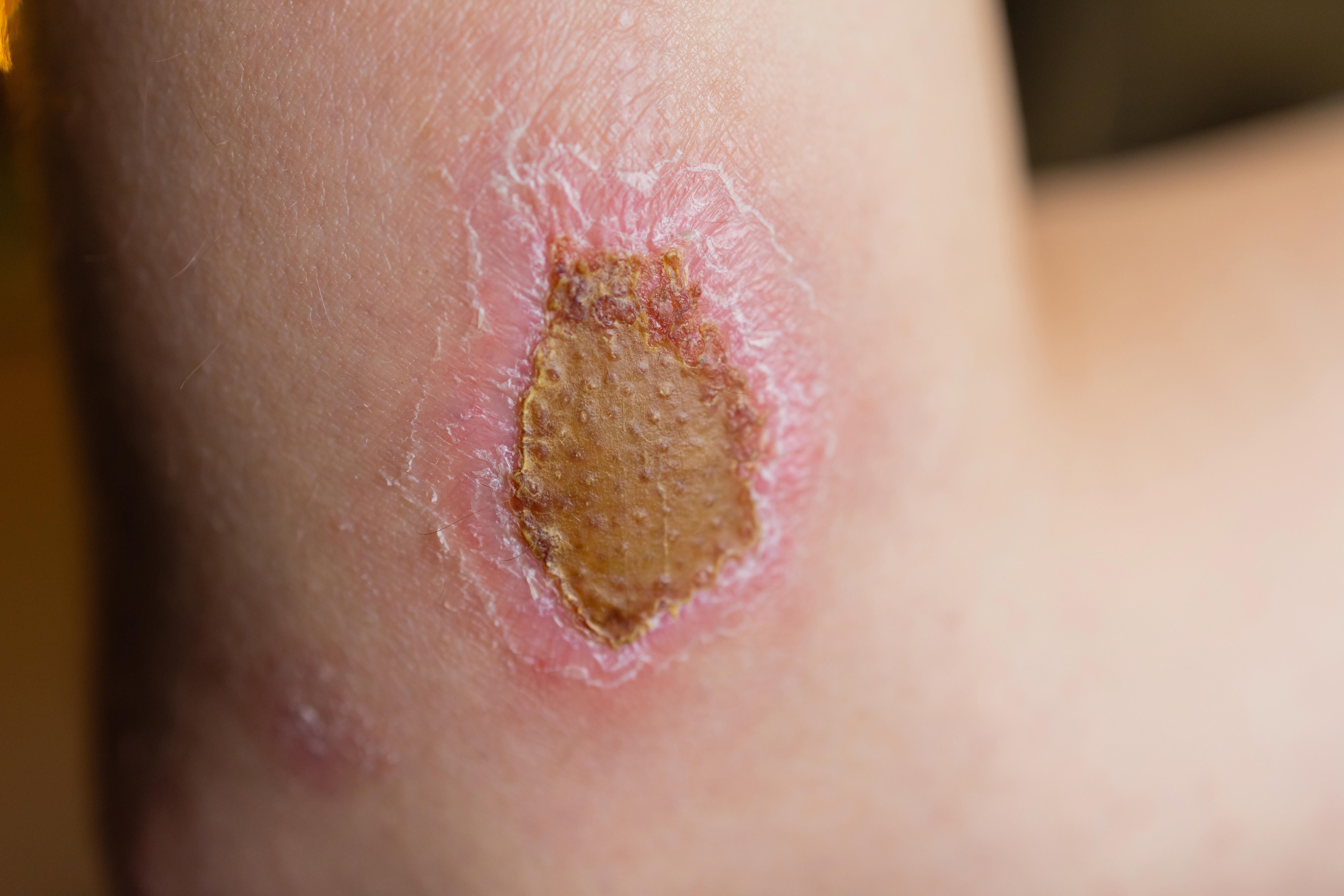 Une plaie sur le coude avec une croute brune et des bords rouges irritation.