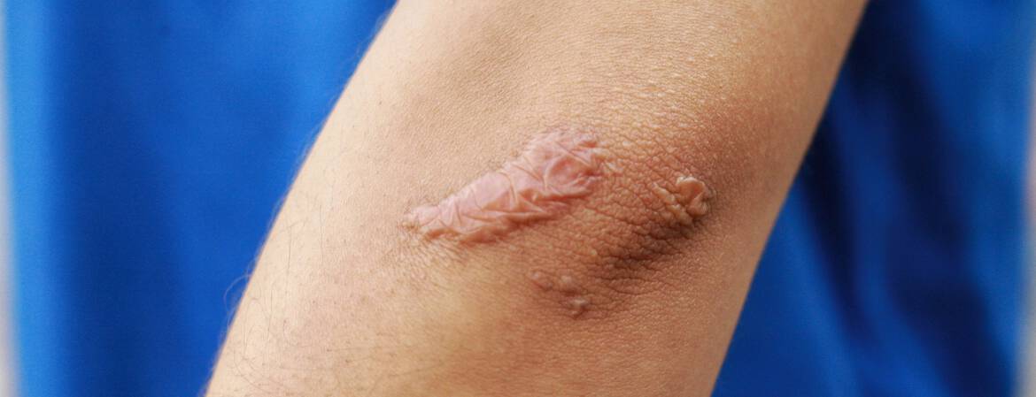 Eczema des mains et des coudes