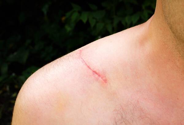 Une cicatrice visible sur l'epaule d'une personne, avec une peau legerement rosee autour.