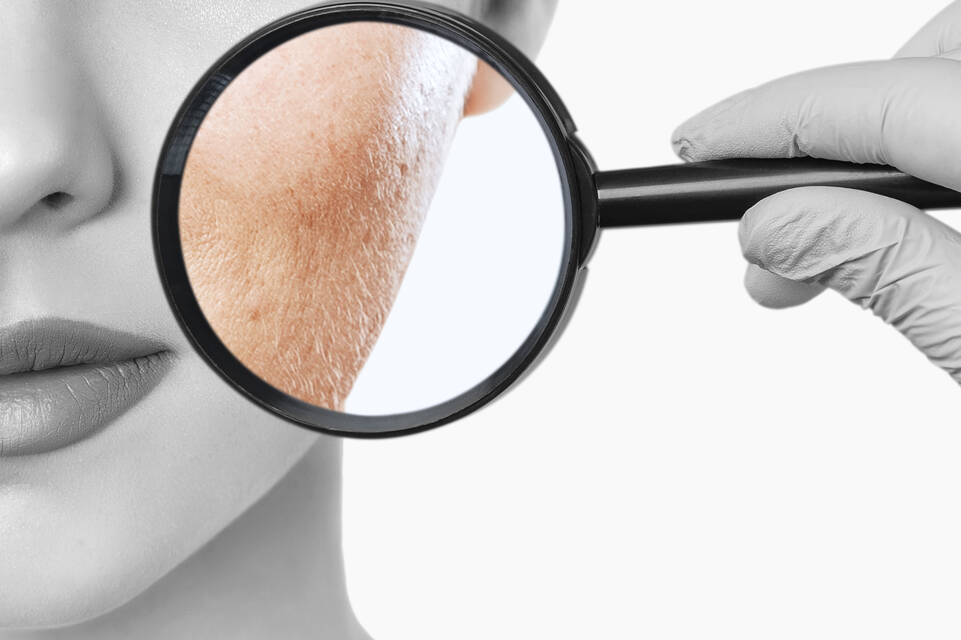 Causes de l’eczema