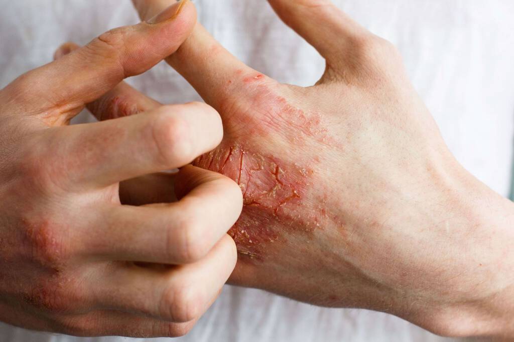 Eczéma ou psoriasis : comment les différencier ? | La Roche-Posay