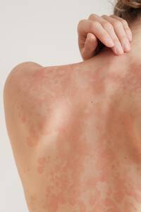 Eczema atopique et eczema chronique des mains