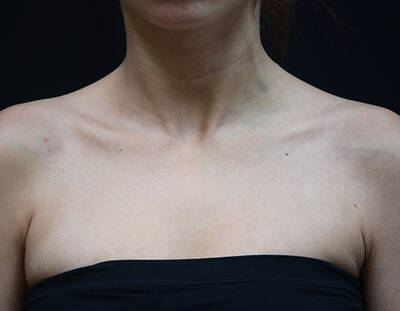 Peau nu du cou et des epaules d'une personne, avec un fond noir.