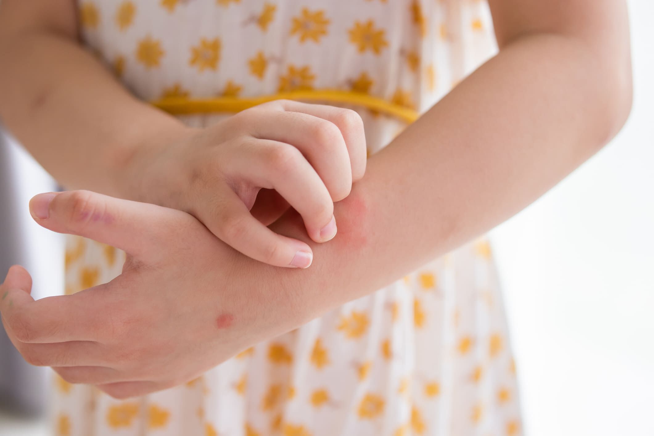 Enfant grattant une plaque rouge sur son bras, evoquant une irritation cutanee ou une demangeaison