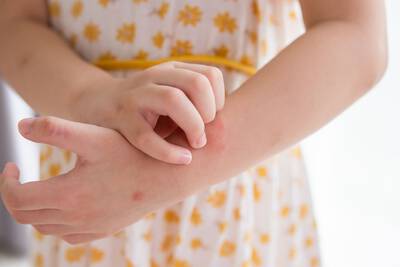 Enfant grattant une plaque rouge sur son bras, evoquant une irritation cutanee ou une demangeaison