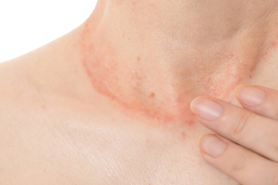 Eczema ou peau seche