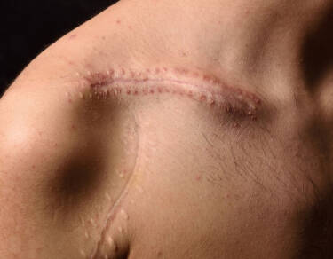 Comment bien cicatriser apres un tatouage