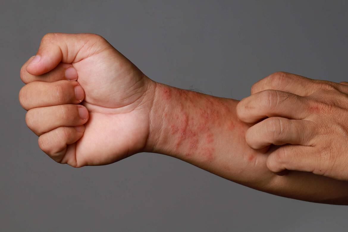 Comment traiter et soulager les plaques d’eczéma ? | La Roche-Posay