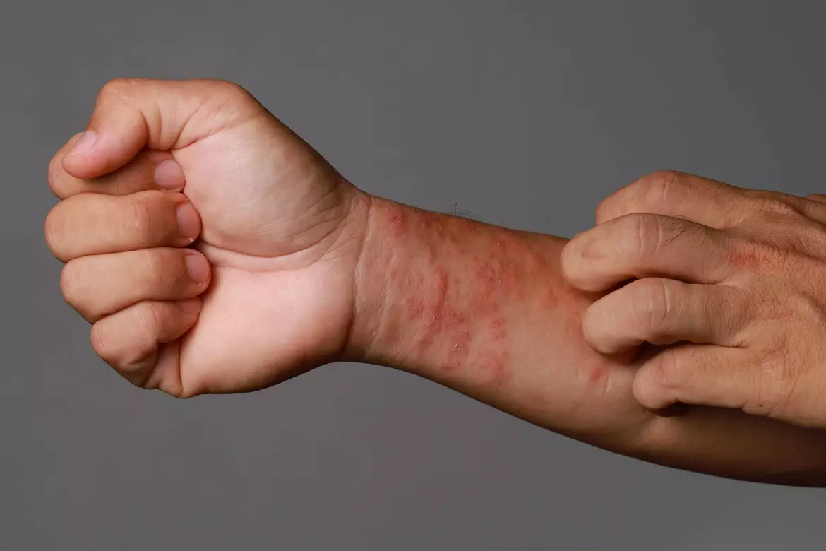 Eczema des mains et des coudes