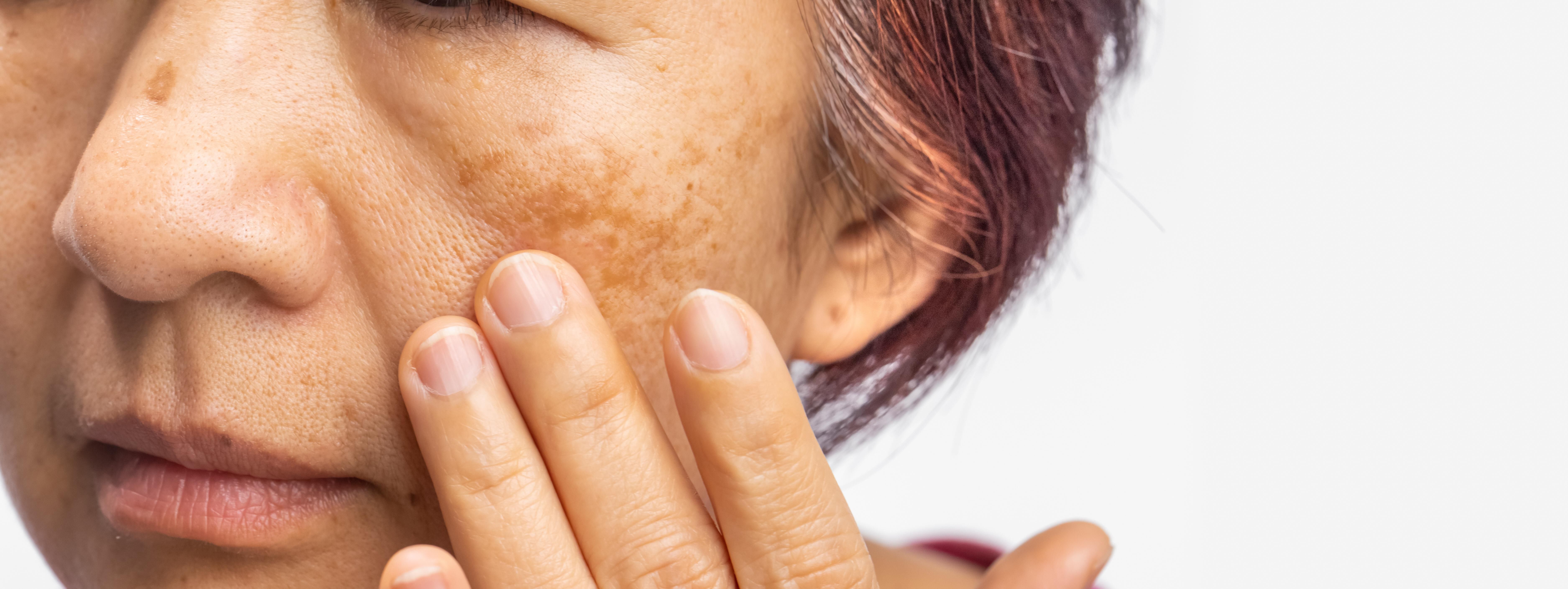 Une femme d'age moyen touche delicatement son visage, mettant en evidence des taches cutanees sur sa joue.