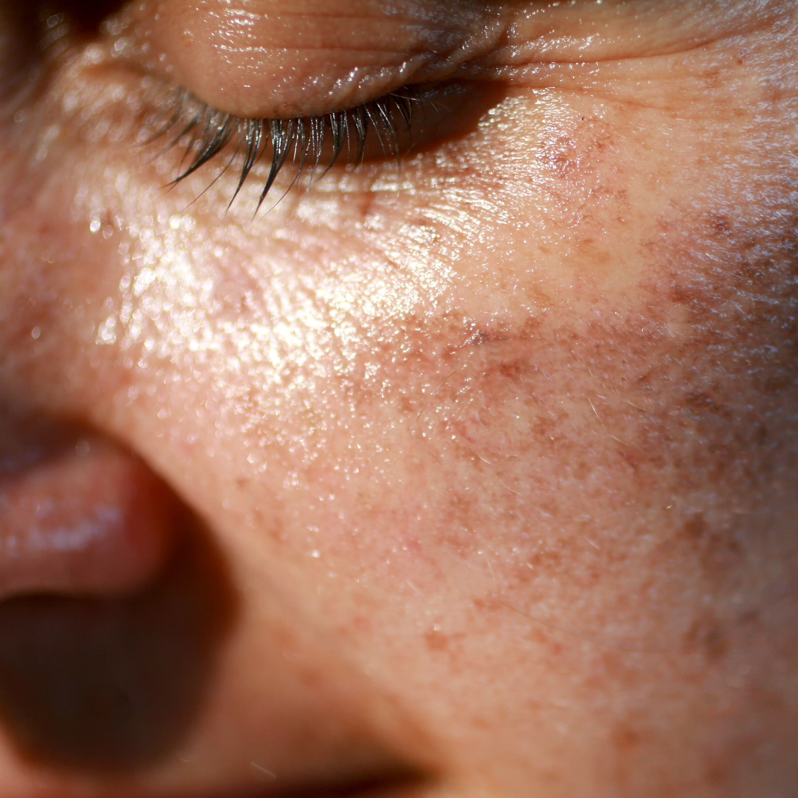 Eczema de contact