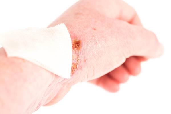 Main montrant une plaie couverte d'un bandage sur le poignet.