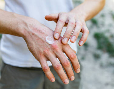 Eczéma des mains et des doigts : causes et traitement | La Roche-Posay