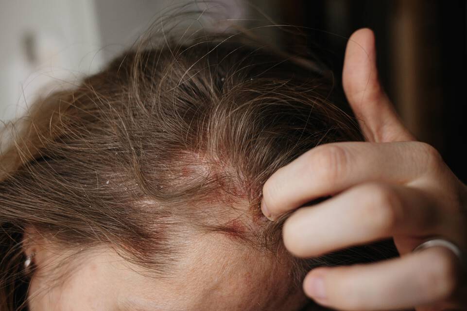 Causes de l’eczema