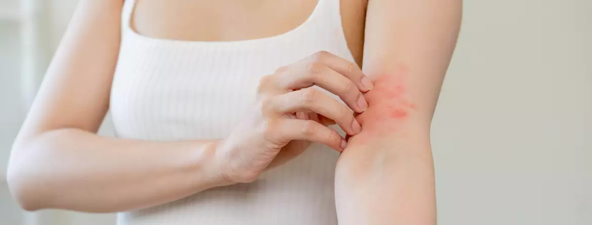 Eczema des mains et des coudes