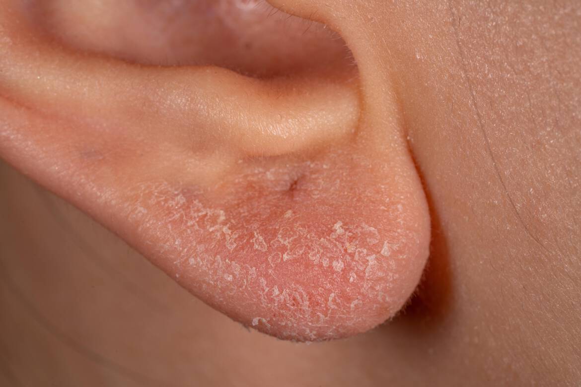 Eczema des mains et des coudes