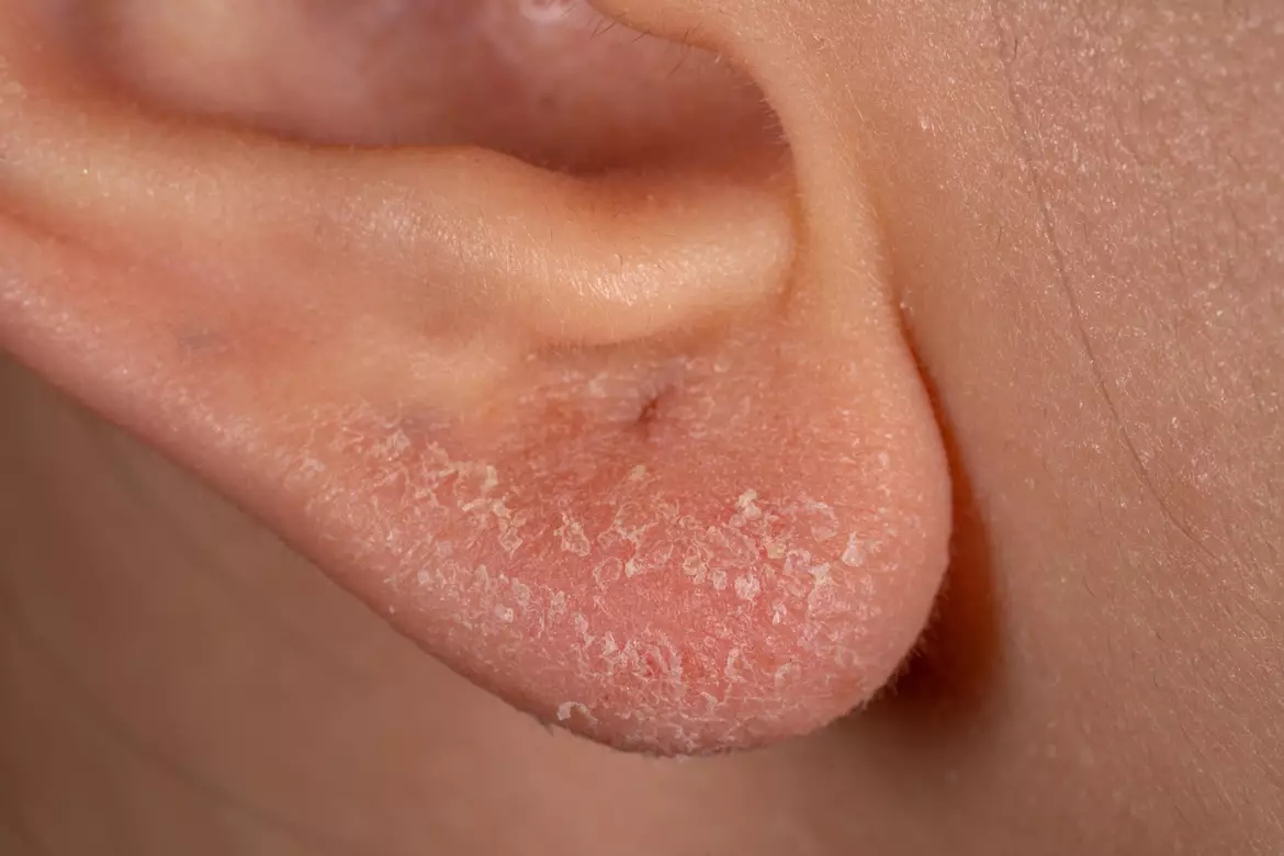 Eczema des mains et des coudes