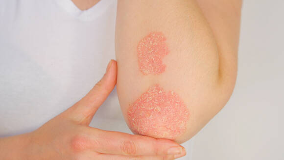 Image montrant une personne tenant son bras avec une peau affectee par le psoriasis sur le coude.