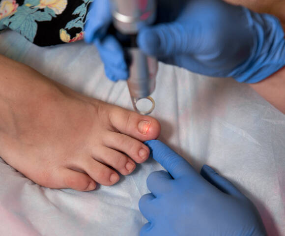 Comment differencier l’eczema des pieds d’une mycose ou d’un psoriasis