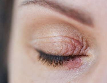 Eczema des yeux et des paupieres : causes et traitement