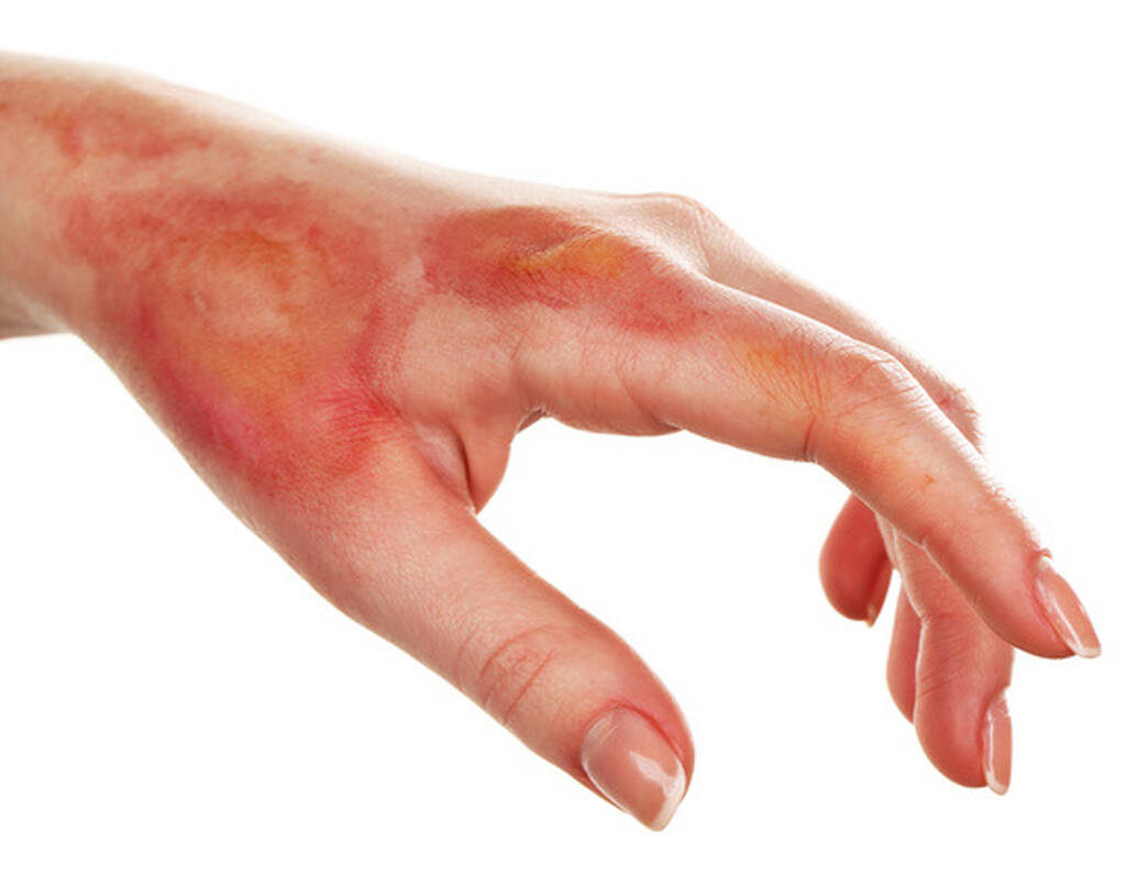 Comment faire disparaitre une cicatrice de brulure ?