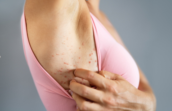 Eczema atopique et eczema chronique des mains