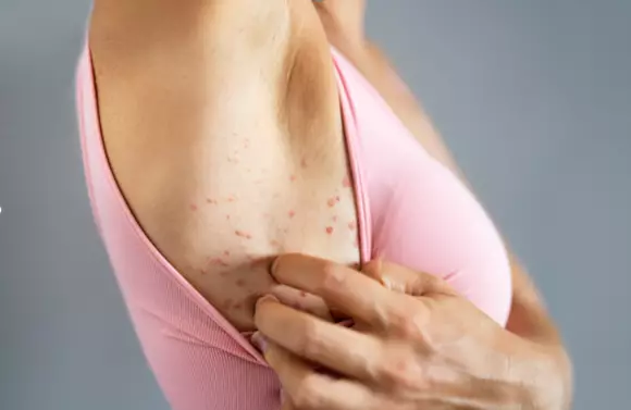 Eczema atopique et eczema chronique des mains