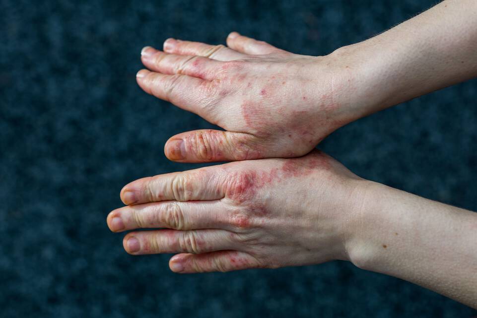Eczema bulleux