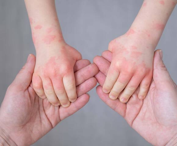 Pourquoi la peau a-t-elle besoin de cicatriser apres un tatouage