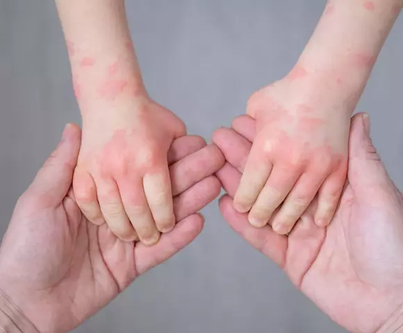 Pourquoi la peau a-t-elle besoin de cicatriser apres un tatouage