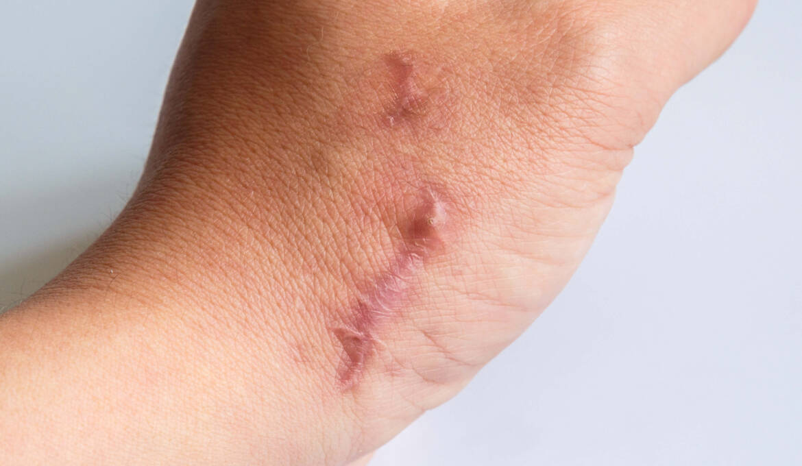 Eczema des mains et des coudes